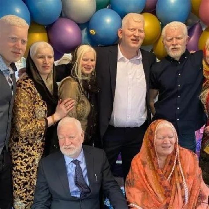 The Whitest Person in the Whole World: Unveiling the Science and Stories Behind Albinism
